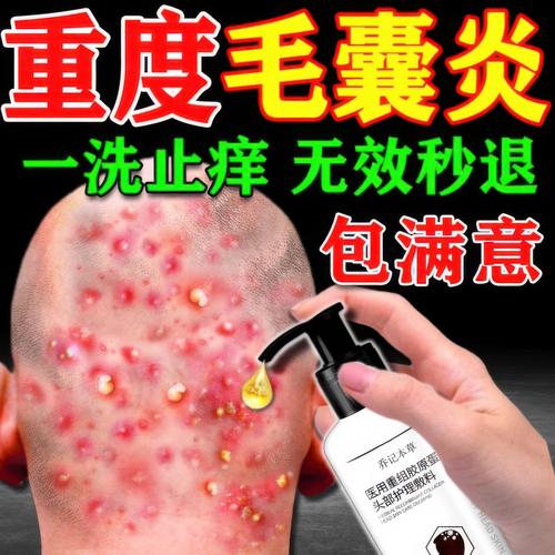头部毛囊炎用什么药