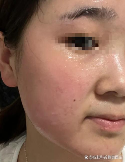 洗面奶洗完敷面膜过敏了怎么办