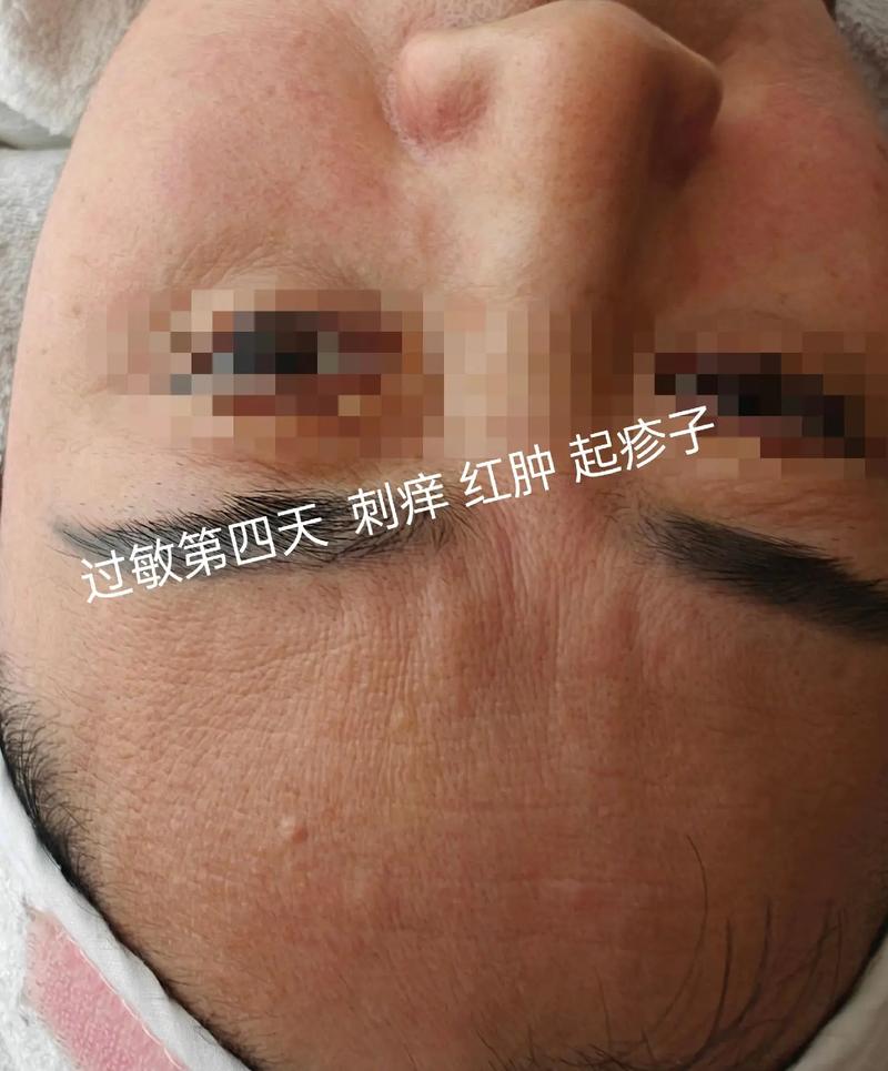 洗面奶洗完敷面膜过敏了怎么办