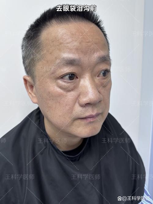 眼袋长什么样图片