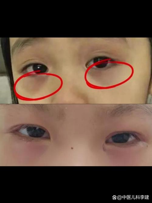 眼袋黑是什么病
