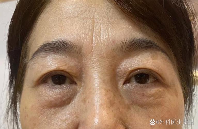 眼袋黑是什么病