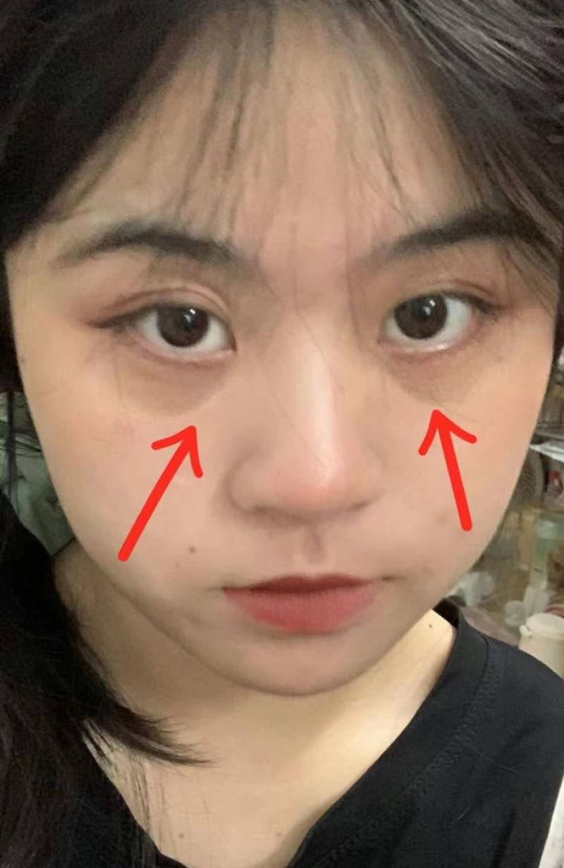 眼袋黑是什么病