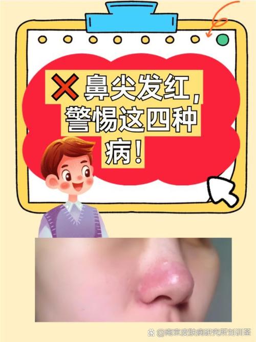 鼻子红为什么