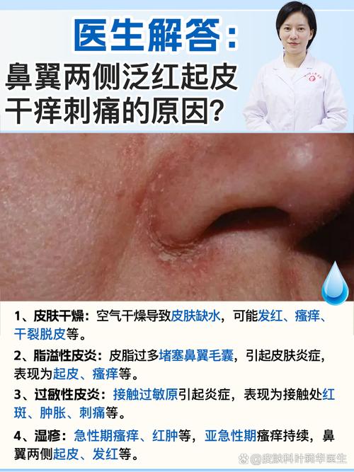 鼻子红为什么