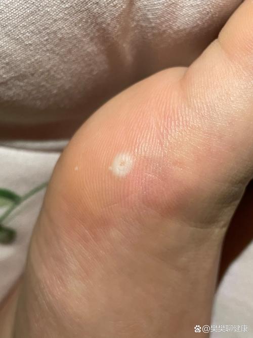 什么是长鸡眼