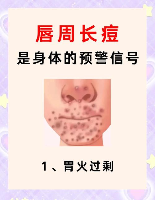 嘴边长痘是什么原因