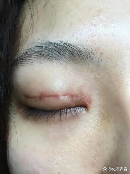 双眼皮为什么会增生