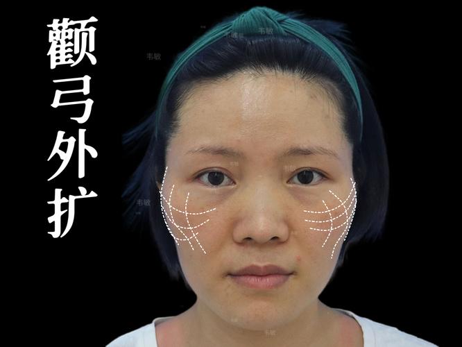 颧骨为什么会外扩