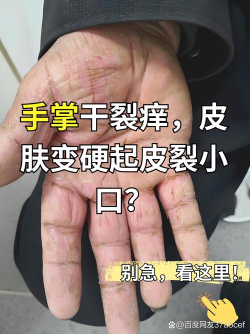 手掌蜕皮是什么原因