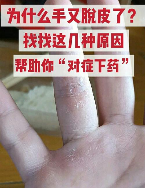 手掌蜕皮是什么原因