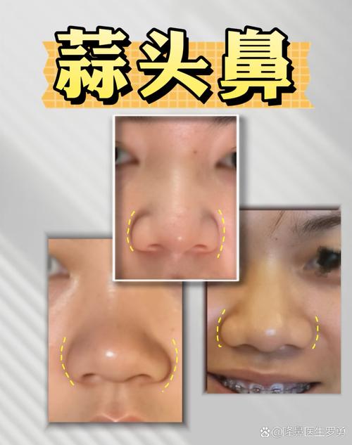 蒜头鼻长什么样