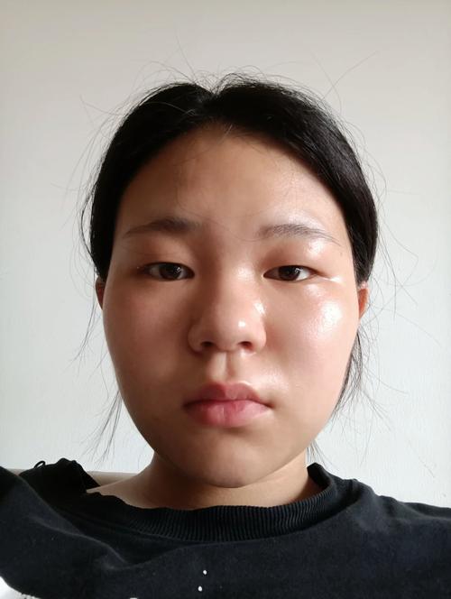 蒜头鼻长什么样