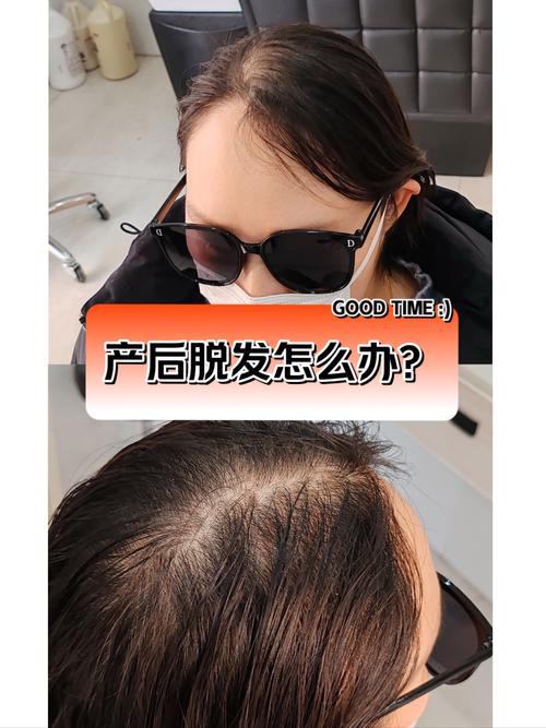 产后脱发是什么原因
