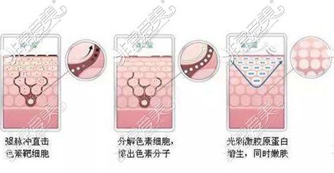 激光祛斑是什么原理