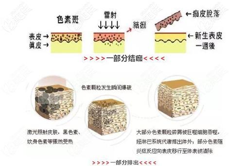 激光祛斑是什么原理