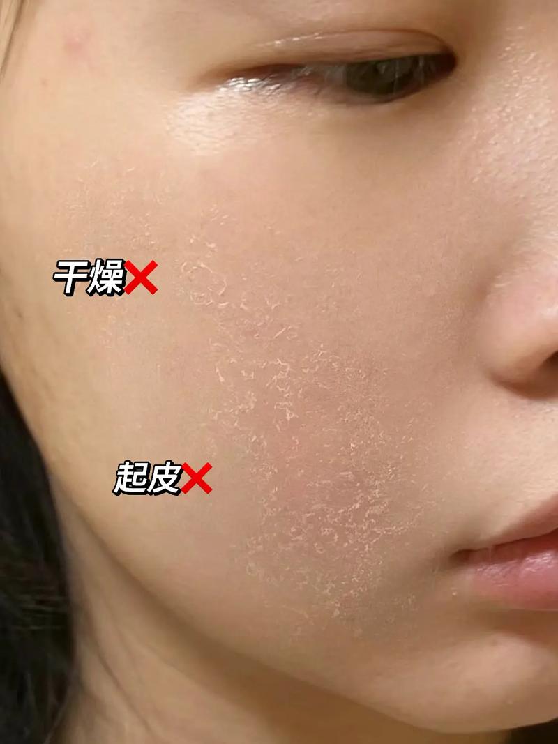 为什么秋天皮肤干燥