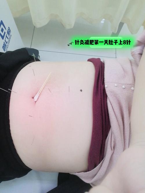 针灸 减肥什么时候 最好