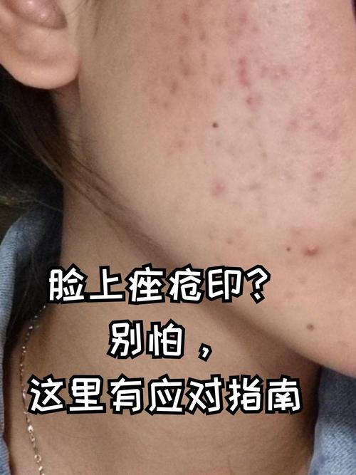 脸上为什么会长痤疮