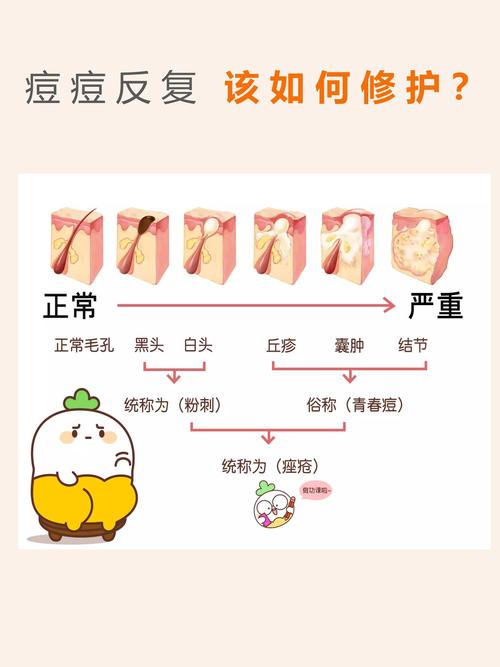 脸上为什么会长痤疮