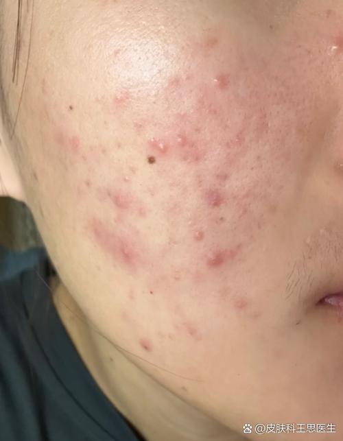 洗面奶洗过脸上起痘痘怎么回事