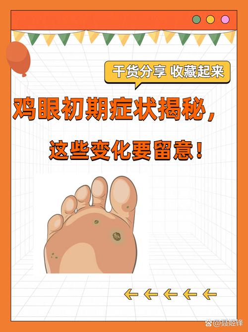 为什么会得鸡眼