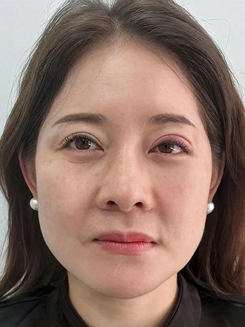 为什么一边脸下垂