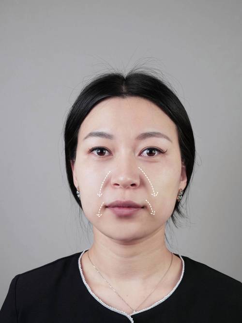 为什么一边脸下垂