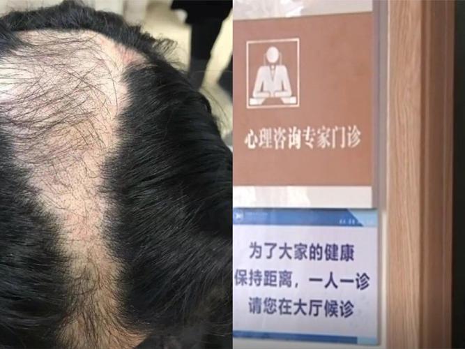 拔头发有什么危害