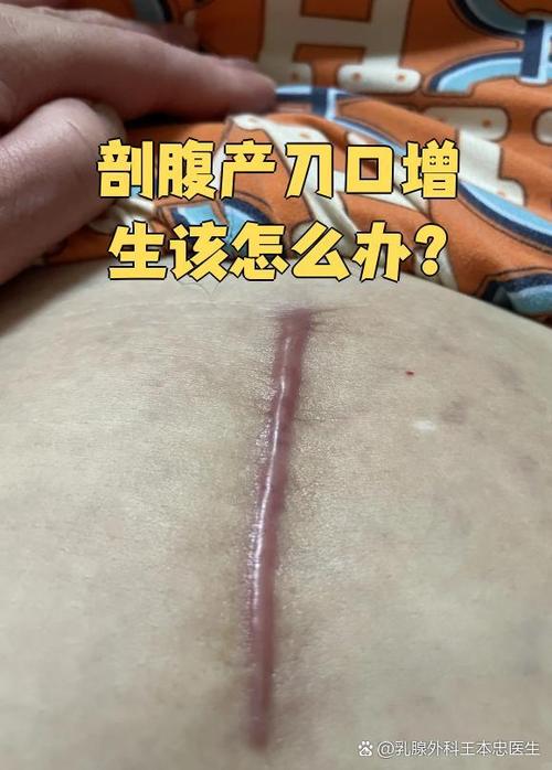 刀口为什么会增生