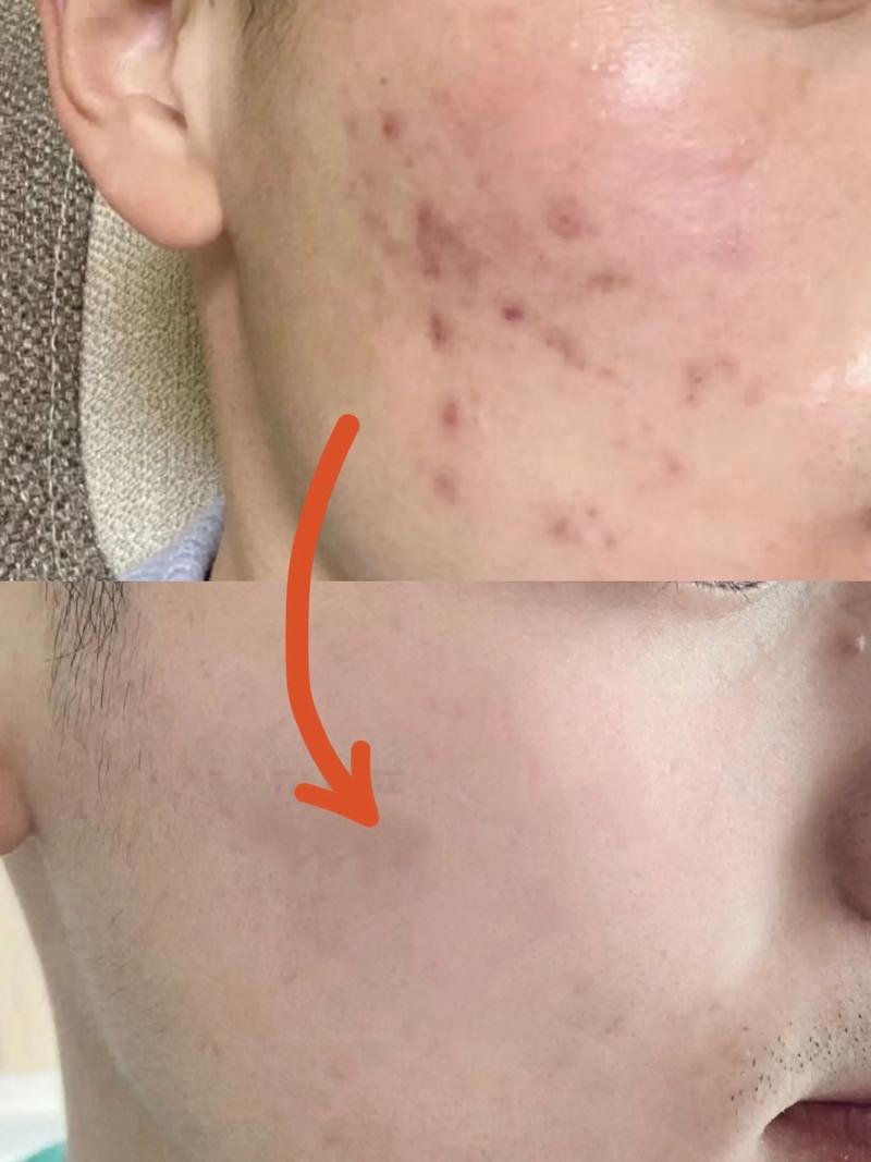 用过洗面奶后脸上起板疙瘩怎么