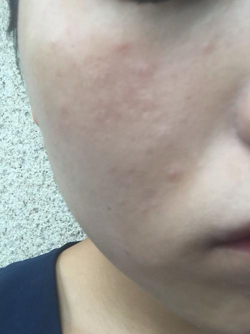用过洗面奶后脸上起板疙瘩怎么