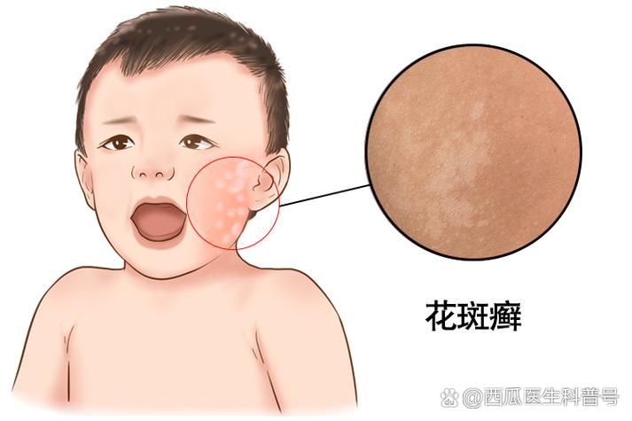 小孩长斑是什么原因
