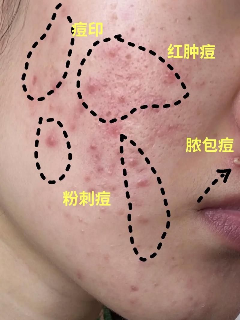 脸上长痘痘是什么病