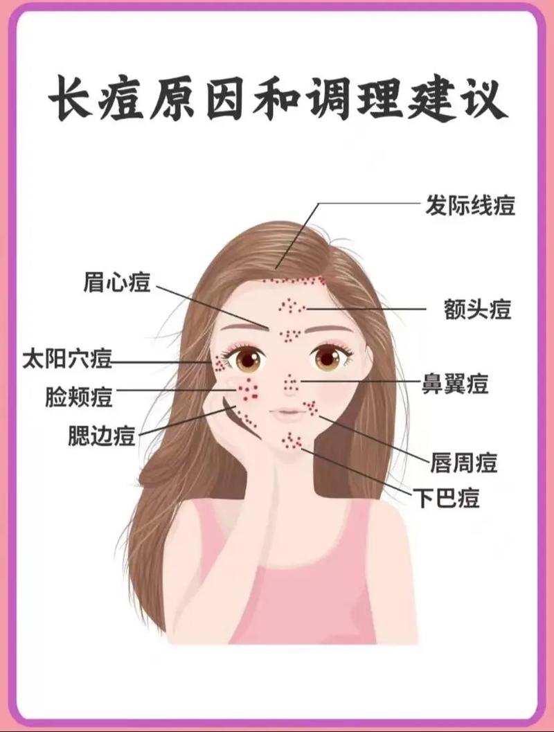 脸上长痘痘是什么病