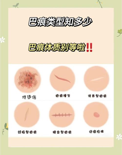 疤痕体质什么意思