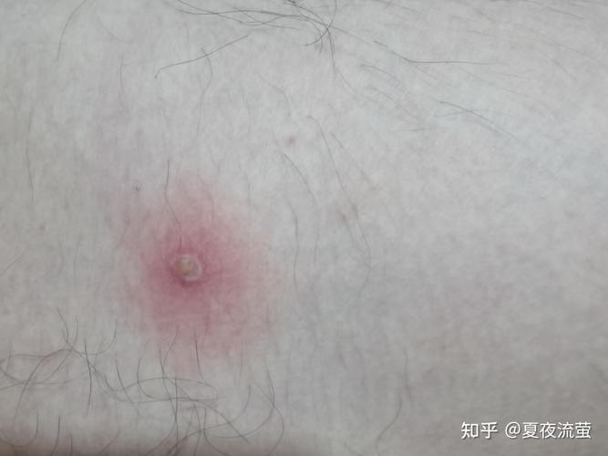 什么是脓包疮