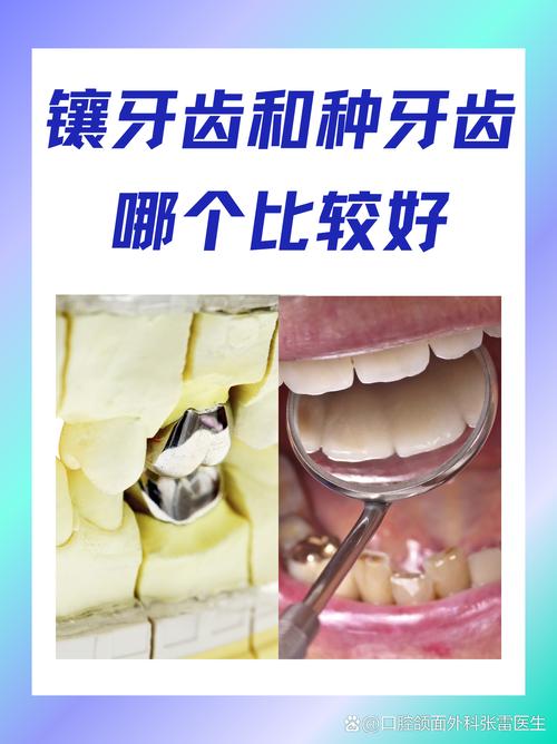 镶牙什么牙最好
