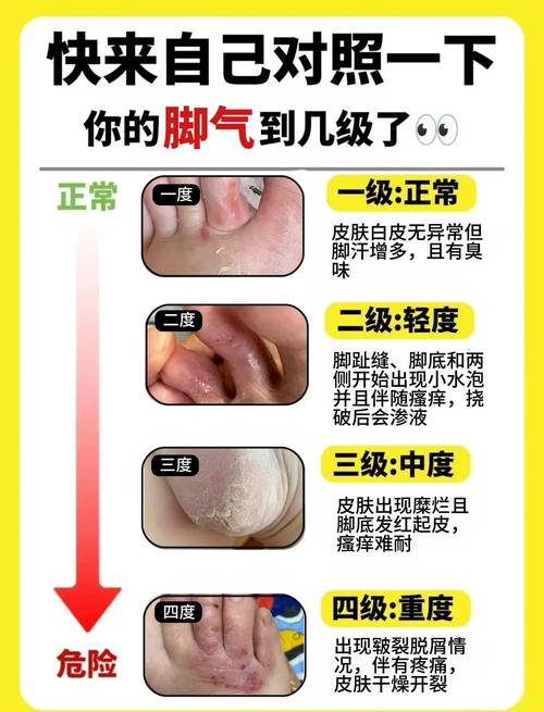 脚气由什么引起
