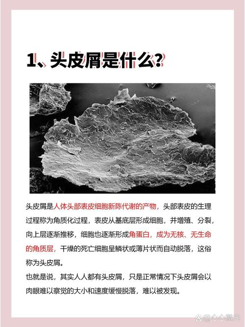 起头皮屑是什么原因