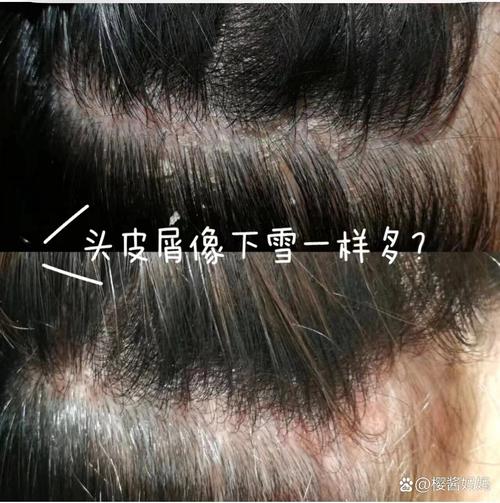 起头皮屑是什么原因