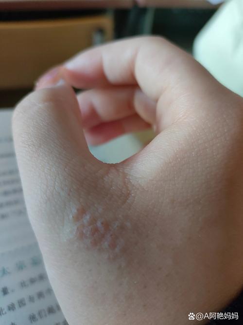 手冻了为什么会痒