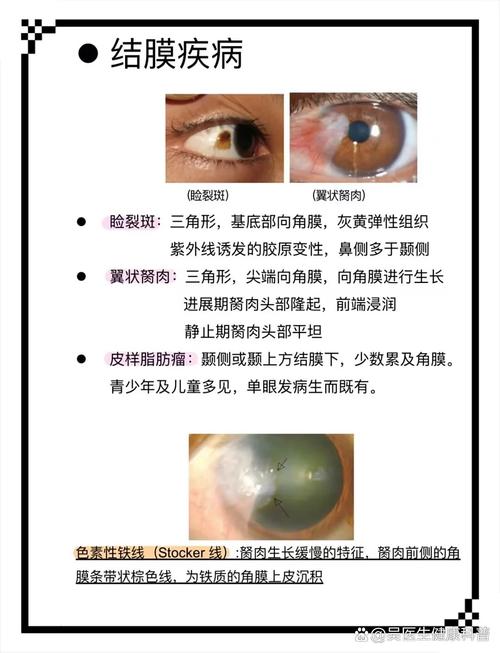 眼角有斑是什么原因