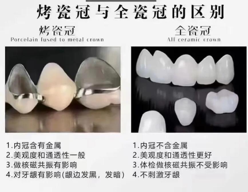 烤瓷牙有什么坏处