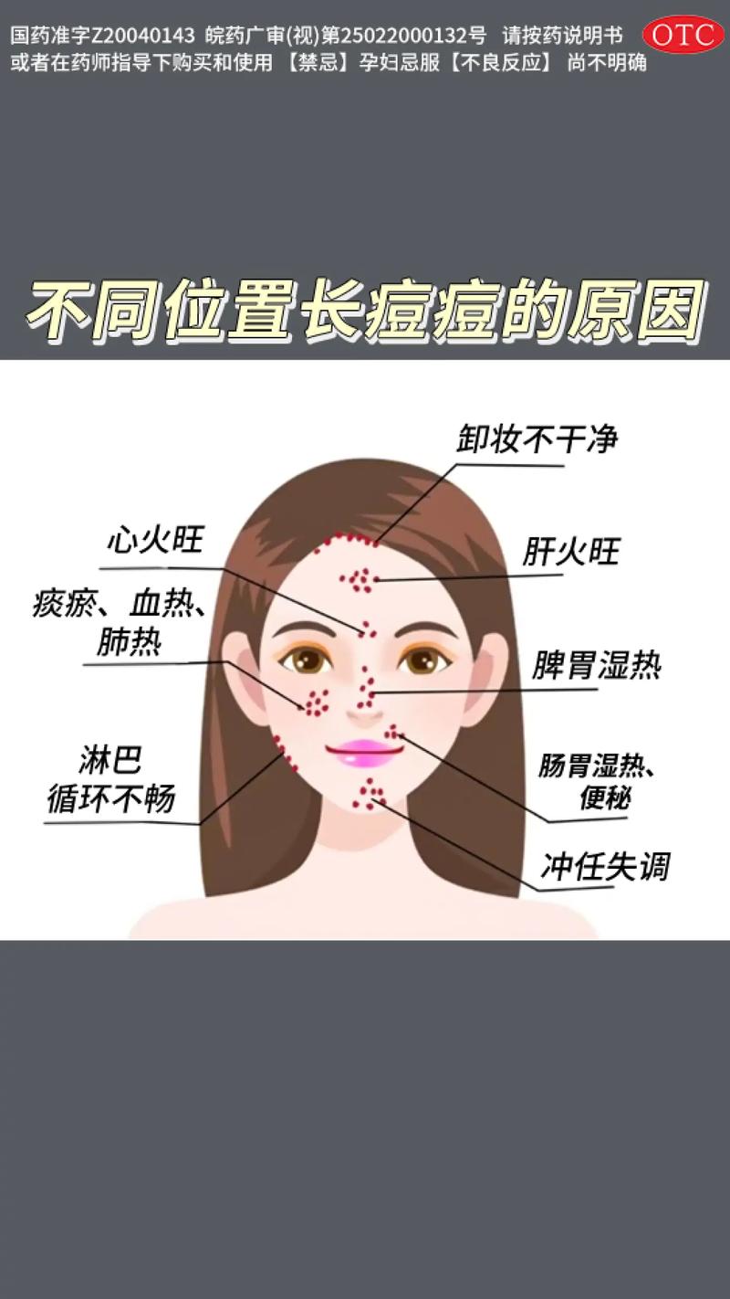 脸上痤疮是什么引起的