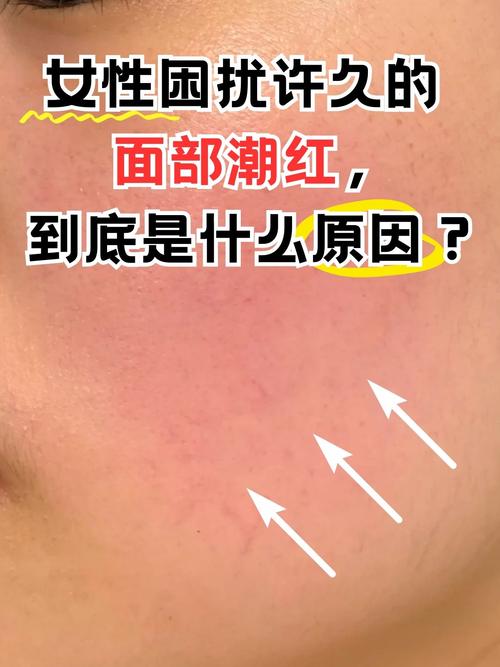 颧骨发红是什么原因