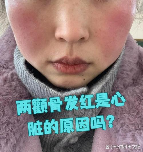 颧骨发红是什么原因