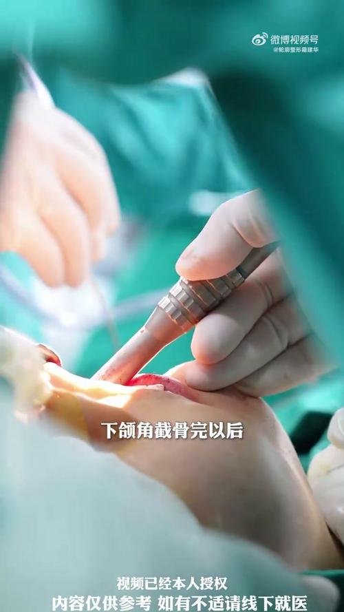 什么是截骨手术