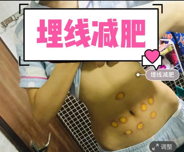 蛋白植入减肥是什么意思