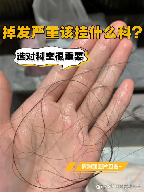 女性脱发挂什么科